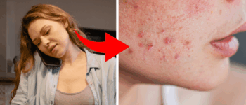 8 Body Parts Prone to Acne and Their Triggers