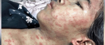 ALERT: New Disease Outbreak in China — Over 7,000 Cases Reported, Symptoms and Risks Revealed…